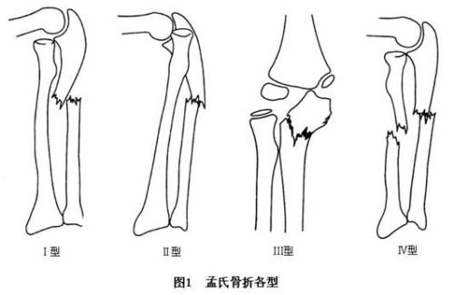骨折手术后吃什么好