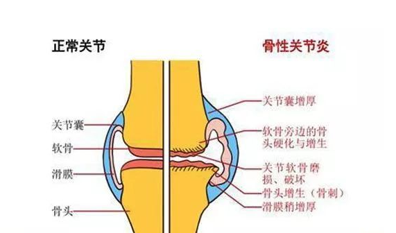 骨关节病能治好吗