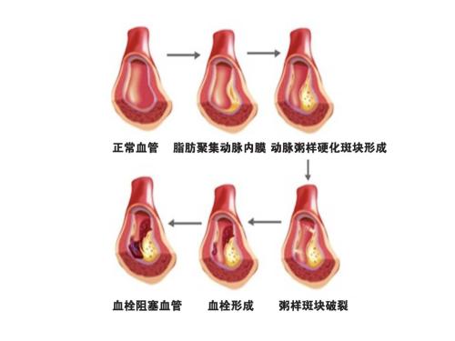 脑血栓形成的三大原因