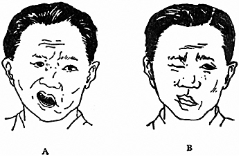 发现轻微面瘫怎么自救