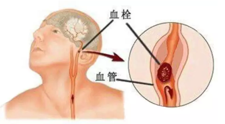 老年脑血栓发作，会出现哪些症状？