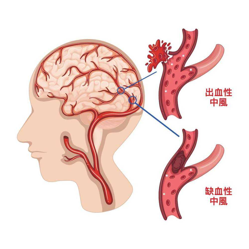 老人脑梗塞的症状有哪些?如何预防脑梗复发?