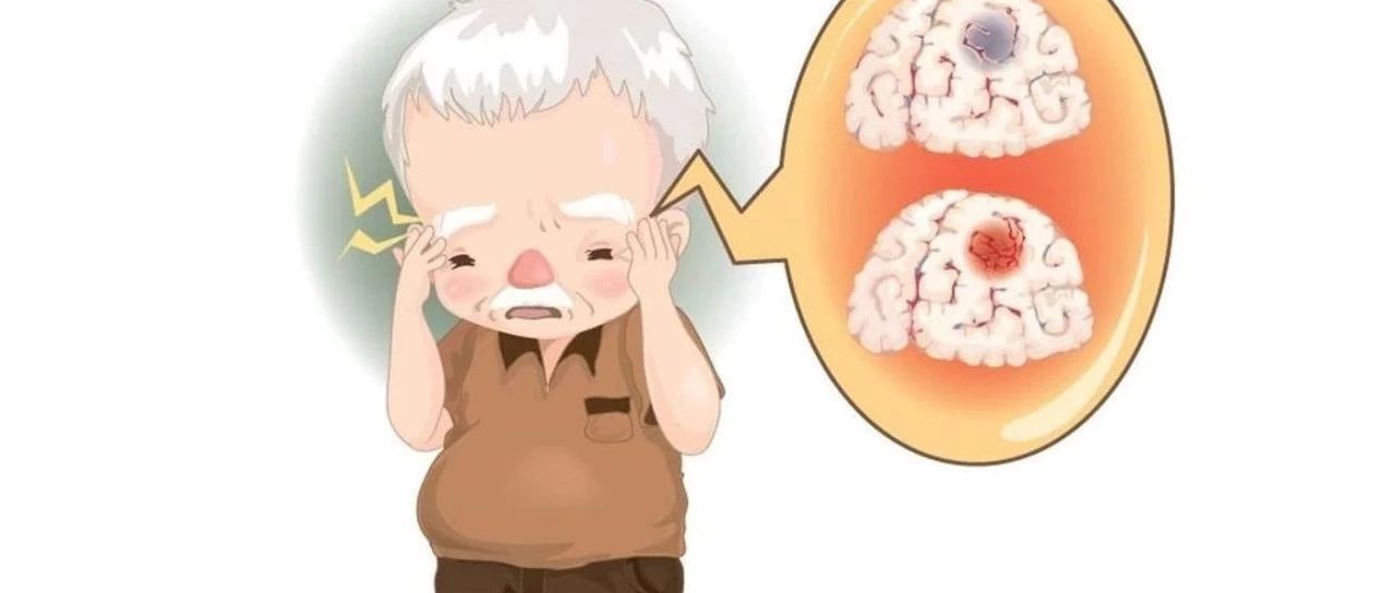 脑梗来临，身体会通风报信，专家提醒：4大症状别忽视!