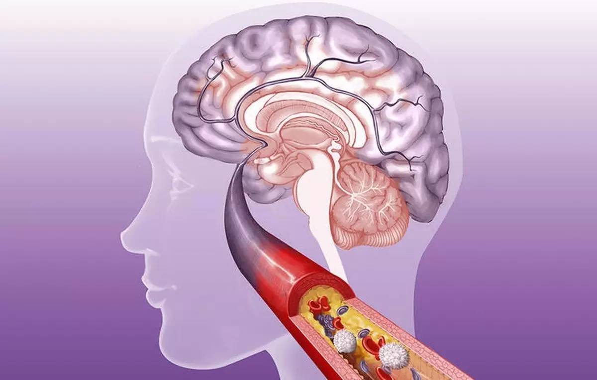 脑梗患者不宜吃这3类食物，早看早知道!
