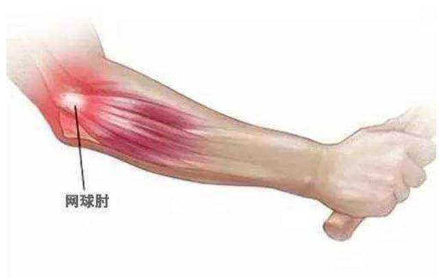 什么是网球肘?如何预防网球肘?