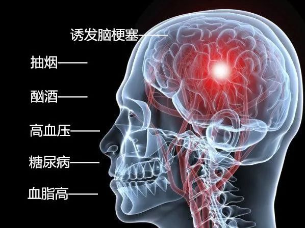脑梗塞早期的6大症状