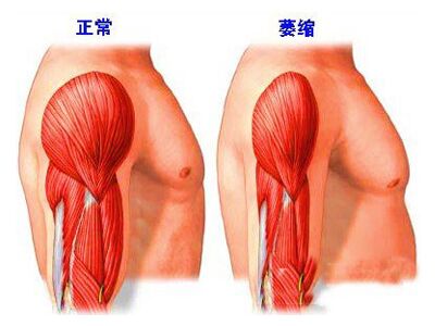 肌肉萎缩患者如何进行有效治疗?