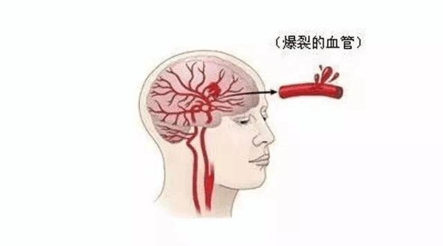 脑出血前的10大救命信号!牢记这7条预防措施!