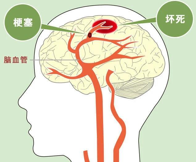 脑梗塞通过锻炼能康复吗?