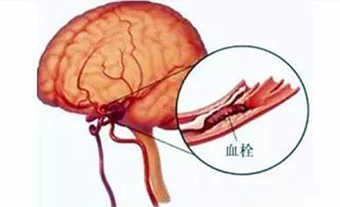 脑血栓最新治疗方法?检查要注意这3点!