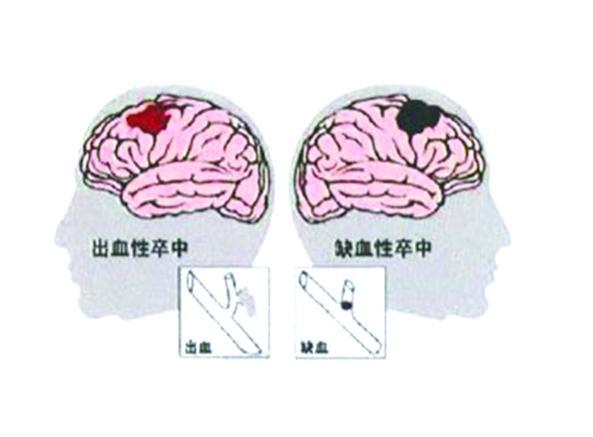脑卒中早期症状识别要点